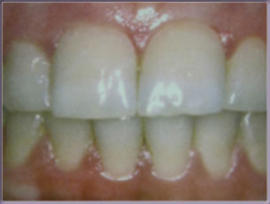 fotos fases periodontitis